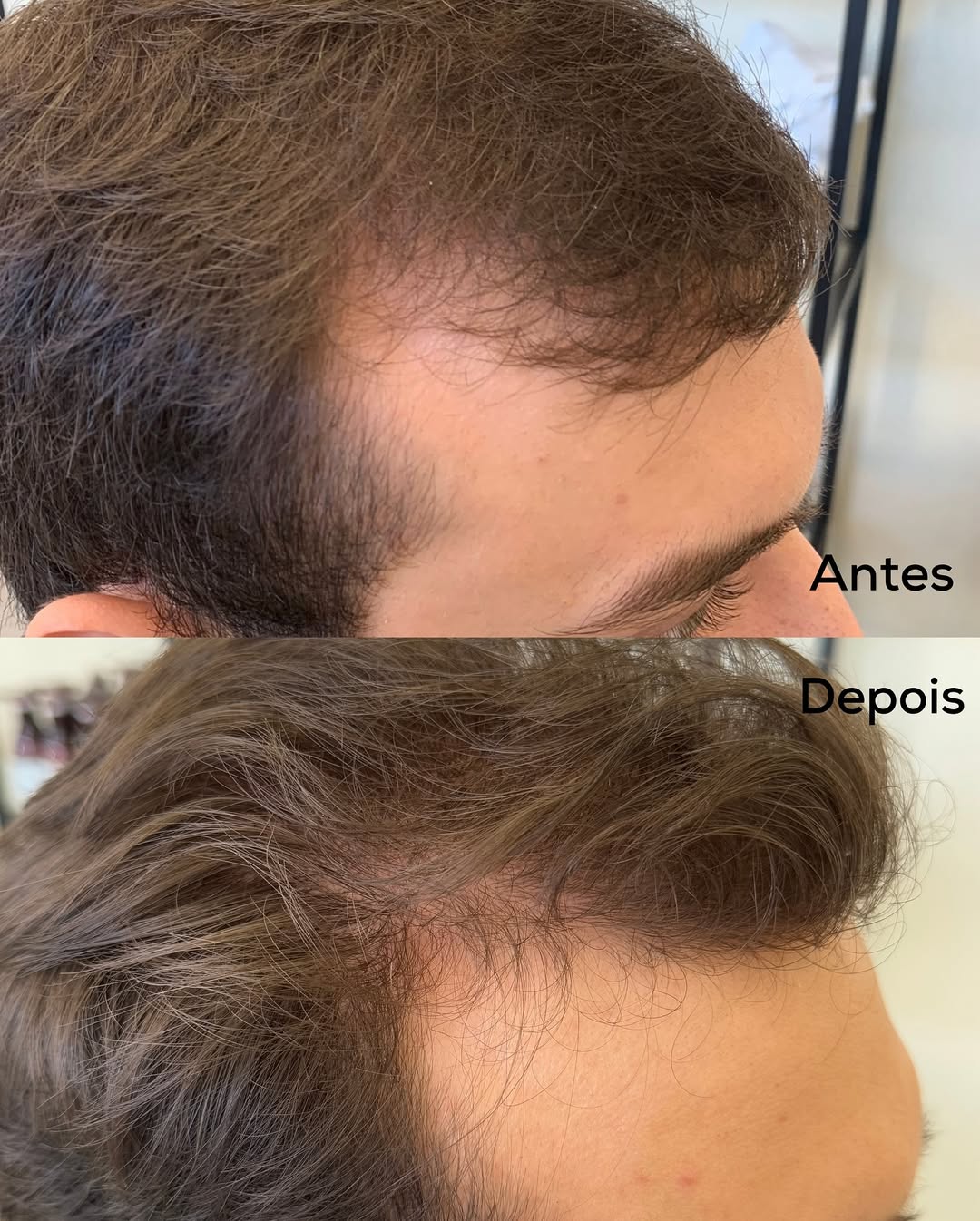 Tratamento de Terapia Capilar 6 semanas para Alopecia Androgenética Padrão Masculino 💆🏻_♂️Este-2