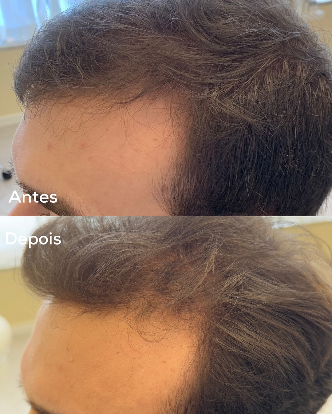 Tratamento de Terapia Capilar 6 semanas para Alopecia Androgenética Padrão Masculino 💆🏻_♂️Este-3