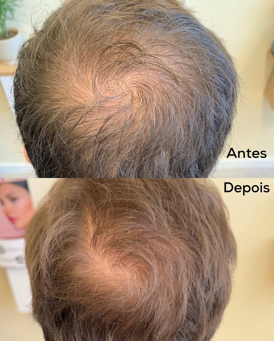 Tratamento de Terapia Capilar 6 semanas para Alopecia Androgenética Padrão Masculino 💆🏻_♂️Este