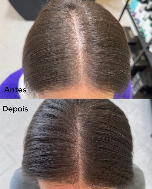 Partilho a evolução de um couro cabeludo com sinais de afinamento capilar e diminuição de densid
